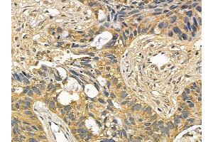 PIKFYVE Mouse Monoclonal Antibody at 1/100 staining human lung cancer and adjacent non-tumor tissue by IHC-P. (PIKFYVE Antikörper)