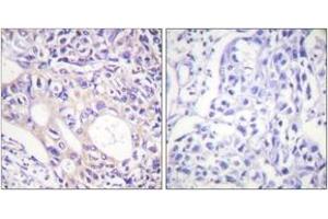 Immunohistochemistry analysis of paraffin-embedded human breast carcinoma, using Aurora Kinase (Phospho-Thr288) Antibody. (Aurora Kinase (AA 256-305), (pThr288) Antikörper)
