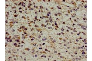Immunohistochemistry of paraffin-embedded human glioma using ABIN7154609 at dilution of 1:100 (ERAL1 Antikörper  (AA 271-382))