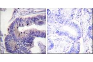 Immunohistochemistry analysis of paraffin-embedded human colon carcinoma tissue, using PDE4D (Ab-190/53) Antibody. (PDE4D Antikörper  (AA 156-205))