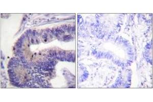 Immunohistochemistry analysis of paraffin-embedded human colon carcinoma tissue, using PDE4D (Ab-190/53) Antibody.