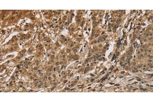 Immunohistochemistry of paraffin-embedded Human gastric cancer using CALU Polyclonal Antibody at dilution of 1:40
