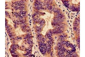 Immunohistochemistry analysis of human colon cancer using ABIN7151715 at dilution of 1:100 (ybeY Antikörper  (AA 54-167))