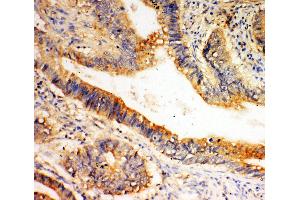 Anti-SLC1A4 antibody, IHC(P) IHC(P): Human Intestinal Cancer Tissue (SLC1A4 Antikörper  (C-Term))