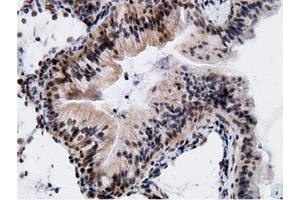 Immunohistochemical staining of paraffin-embedded Adenocarcinoma of Human breast tissue using anti-EPM2AIP1 mouse monoclonal antibody. (EPM2AIP1 Antikörper)