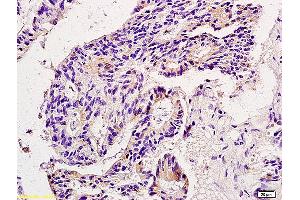 Formalin-fixed and paraffin embedded human colon carcinoma labeled with Anti-MMP9 Polyclonal Antibody, Unconjugated (ABIN873171) at 1:200 followed by conjugation to the secondary antibody and DAB staining. (MMP 9 Antikörper  (AA 151-250))