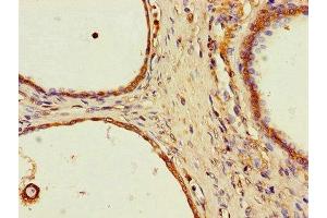 Immunohistochemistry of paraffin-embedded human prostate cancer using ABIN7169623 at dilution of 1:100 (SPPL2A Antikörper  (AA 26-172))