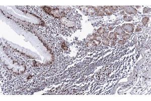 IHC-P Image Immunohistochemical analysis of paraffin-embedded human gastric cancer, using DDX39, antibody at 1:100 dilution. (BAT1 Antikörper  (Center))