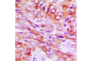 Immunohistochemical analysis of TMBIM1 staining in human breast cancer formalin fixed paraffin embedded tissue section. (TMBIM1 Antikörper  (C-Term))
