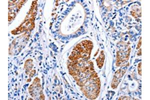 The image on the left is immunohistochemistry of paraffin-embedded Human stomach cancer tissue using ABIN7191274(LIF Antibody) at dilution 1/25, on the right is treated with synthetic peptide. (LIF Antikörper)