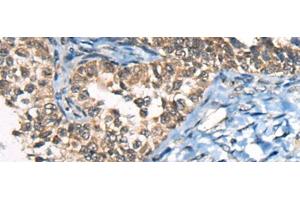 Immunohistochemistry of paraffin-embedded Human ovarian cancer tissue using CDKL4 Polyclonal Antibody at dilution of 1:45(x200) (CDKL4 Antikörper)