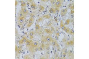 Immunohistochemistry of paraffin-embedded human liver cancer using EIF4G1 Antibody (ABIN5975844) at dilution of 1/100 (40x lens). (EIF4G1 Antikörper)