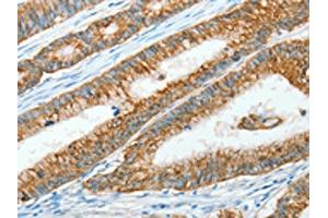 The image on the left is immunohistochemistry of paraffin-embedded Human colon cancer tissue using ABIN7128299(AGR3 Antibody) at dilution 1/15, on the right is treated with fusion protein. (AGR3 Antikörper)