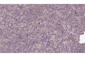 ABIN6273142 at 1/100 staining Human lymph cancer tissue by IHC-P. (Myosin XVIIIA Antikörper  (Internal Region))