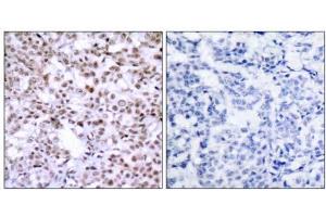 Immunohistochemical analysis of paraffin-embedded human breast carcinoma tissue using Chk2 (Ab-68) antibody (E021087). (CHEK2 Antikörper)