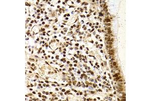Immunohistochemistry of paraffin-embedded human gastric cancer using XRCC4 Antibody.