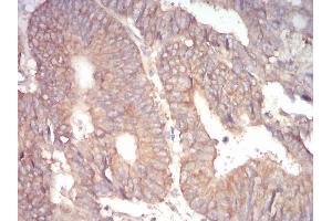 Immunohistochemical analysis of paraffin-embedded rectum cancer tissues using 1-193 mouse mAb with DAB staining.