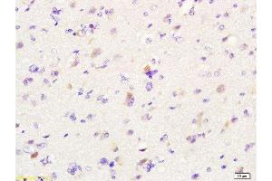 Formalin-fixed and paraffin embedded human glioma labeled with Anti-MIF Polyclonal Antibody, Unconjugated  at 1:200 followed by conjugation to the secondary antibody and DAB staining. (MIF Antikörper  (AA 51-115))