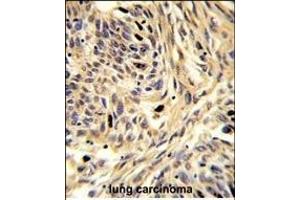 Formalin-fixed and paraffin-embedded human lung carcinoma reacted with HSPD1 Antibody (C-term), which was peroxidase-conjugated to the secondary antibody, followed by DAB staining. (HSPD1 Antikörper  (C-Term))