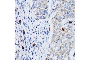 Immunohistochemistry of paraffin-embedded human lung cancer using MAP1LC3B antibody. (LC3B Antikörper)