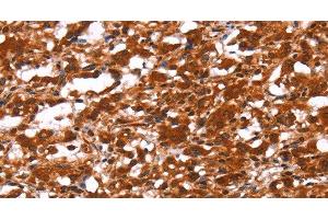 Immunohistochemistry of paraffin-embedded Human thyroid cancer using FUT1 Polyclonal Antibody at dilution of 1:30 (FUT1 Antikörper)