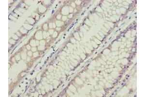 Immunohistochemistry of paraffin-embedded human colon cancer using ABIN7153839 at dilution of 1:100 (GCSAML Antikörper  (AA 1-135))