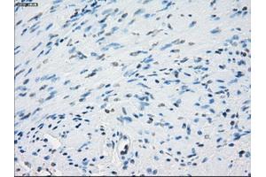 Immunohistochemical staining of paraffin-embedded Adenocarcinoma of colon tissue using anti-AURKCmouse monoclonal antibody. (Aurora Kinase C Antikörper)