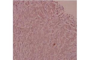 Immunohistochemistry analysis of ADM Antibody in paraffin-embedded human breast carcinoma tissue at 1/100. (Adrenomedullin Antikörper)