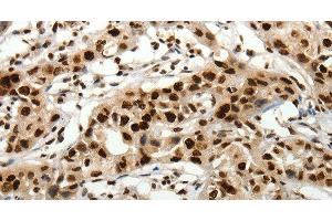 Immunohistochemistry of paraffin-embedded Human lung cancer tissue using SCN1A Polyclonal Antibody at dilution 1:40 (SCN1A Antikörper)