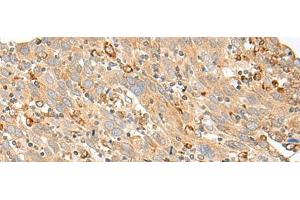Immunohistochemistry of paraffin-embedded Human cervical cancer tissue using SLC5A1 Polyclonal Antibody at dilution of 1:80(x200) (SLC5A1 Antikörper)