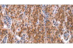Immunohistochemistry of paraffin-embedded Human gastric cancer using GH1 Polyclonal Antibody at dilution of 1:40 (Growth Hormone 1 Antikörper)