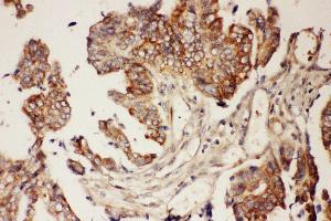 Anti-CNTF Picoband antibody,  IHC(P): Human Intestinal Cancer Tissue (CNTF Antikörper  (AA 2-200))