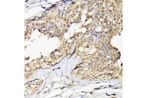 Immunohistochemistry of paraffin-embedded human breast cancer using T Rabbit pAb (ABIN6129486, ABIN6148851, ABIN6148852 and ABIN6223435) at dilution of 1:200 (40x lens). (TARBP2 Antikörper  (AA 1-366))