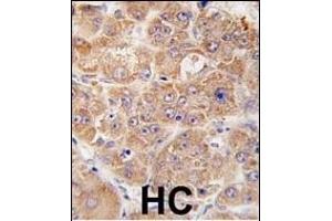Formalin-fixed and paraffin-embedded human hepatocarcinoma tissue reacted with hUVRAG (N-term ), which was peroxidase-conjugated to the secondary antibody, followed by DAB staining. (UVRAG Antikörper  (AA 120-152))