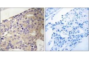 Immunohistochemistry analysis of paraffin-embedded human breast carcinoma tissue, using PEX10 Antibody. (PEX10 Antikörper  (AA 183-232))