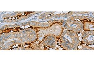 Immunohistochemistry of paraffin-embedded Human thyroid cancer tissue using ENKD1 Polyclonal Antibody at dilution of 1:75(x200) (ENKD1 Antikörper)