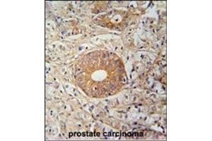 Immunohistochemistry analysis in Formalin Fixed, Paraffin Embedded Human prostate carcinoma stained with SLC35E2 Antibody (N-term) followed by peroxidase conjugation of the secondary antibody and DAB staining.
