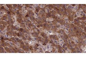 ABIN6277338 at 1/100 staining Human liver cancer tissue by IHC-P. (CDH23 Antikörper  (N-Term))