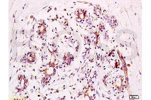 Formalin-fixed and human breast carcinoma tissue labeled with Anti-phospho-BACH1/BRIP1(Ser990) Polyclonal Antibody, Unconjugated  at 1:200 followed by conjugation to the secondary antibody and DAB staining (BRIP1 Antikörper  (pSer990))