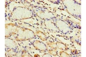 Immunohistochemistry of paraffin-embedded human gastric cancer using ABIN7172261 at dilution of 1:100 (TLR1 Antikörper  (AA 25-580))