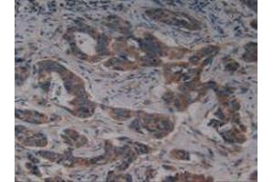 IHC-P analysis of Human Breast Cancer Tissue, with DAB staining. (KIT Antikörper  (AA 321-520))