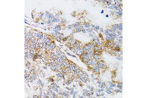 Immunohistochemistry of paraffin-embedded human gastric cancer using PDYN antibody. (PDYN Antikörper)