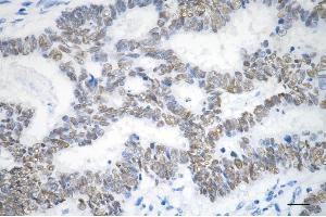 Immunohistochemistry was performed on paraffin-embedded human sigmoid colon carcinoma using SOX9 antibody (ABIN7800973), 1:200).