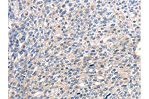 The image on the left is immunohistochemistry of paraffin-embedded Human breast cancer tissue using ABIN7127958(CENPM Antibody) at dilution 1/30, on the right is treated with fusion protein. (CENPM Antikörper)