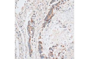 Immunohistochemistry of paraffin-embedded human colon carcinoma using HMGCR antibody (ABIN6293218) at dilution of 1:100 (40x lens).
