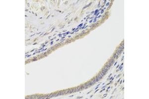 Immunohistochemistry of paraffin-embedded human adenomyosis using HDAC4 Antibody (ABIN5975864) at dilution of 1/100 (40x lens). (HDAC4 Antikörper)