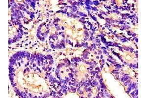 Immunohistochemistry of paraffin-embedded human colon cancer using ABIN7156464 at dilution of 1:100 (CD11b Antikörper  (AA 46-150))