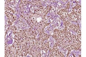 Paraformaldehyde-fixed, paraffin embedded Human stomach cancer Antigen retrieval by boiling in sodium citrate buffer (pH6. (Cytokeratin 18 Antikörper  (pSer60))