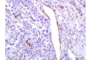 Formalin-fixed and paraffin embedded human lung carcinoma labeled with Anti-Phospho-PLK1 (Ser137) Polyclonal Antibody, Unconjugated (ABIN744938) at 1:200 followed by conjugation to the secondary antibody and DAB staining (PLK1 Antikörper  (pSer137))
