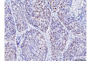 IHC analysis of MSH2 using anti-MSH2 antibody (ABIN7601369). (MSH2 Antikörper  (AA 337-583))